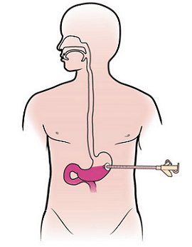 Diagram - PEG (feeding) Tube